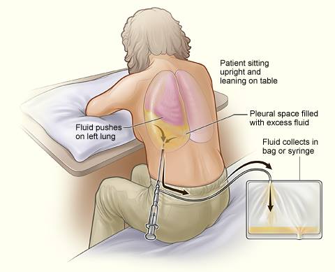 Thoracentesis Procedure